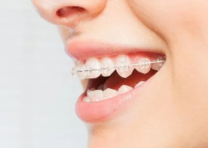 side view of smiling mouth with clear braces on teeth, clear braces Sioux Falls, SD orthodontist