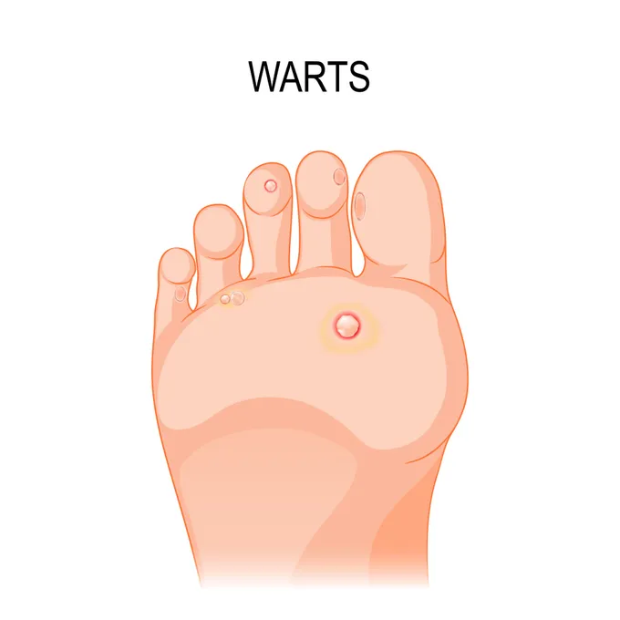 Plantar Warts