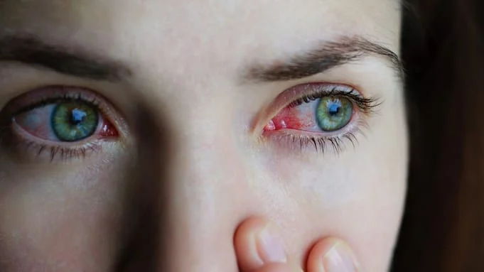woman suffering from pink eye
