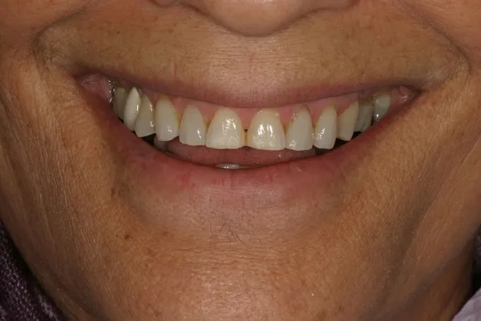 Before Porcelain Veneers, Honolulu