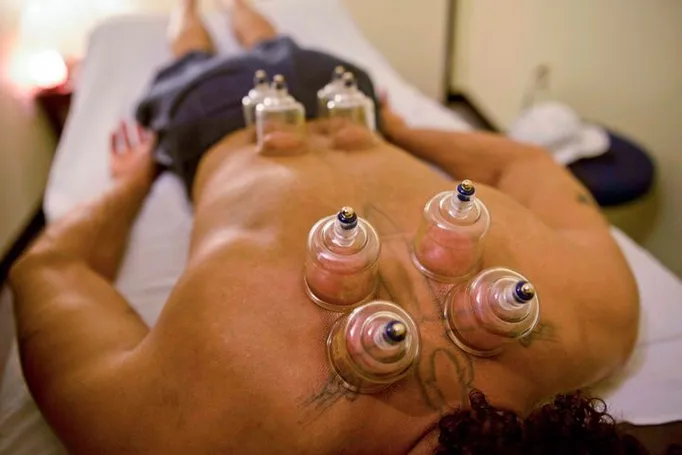 cupping