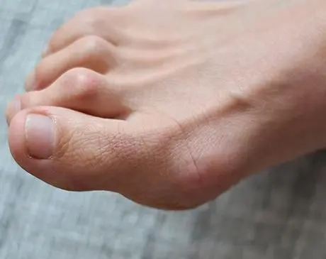 Hammertoe Treatment