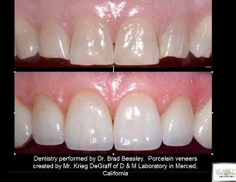 porcelain veneers