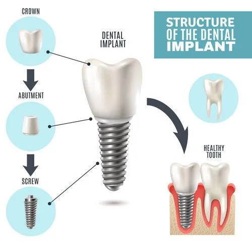 diagram illustration "Structure of the Dental Implant" showing implant parts, implant dentistry Brookline, MA dental implants