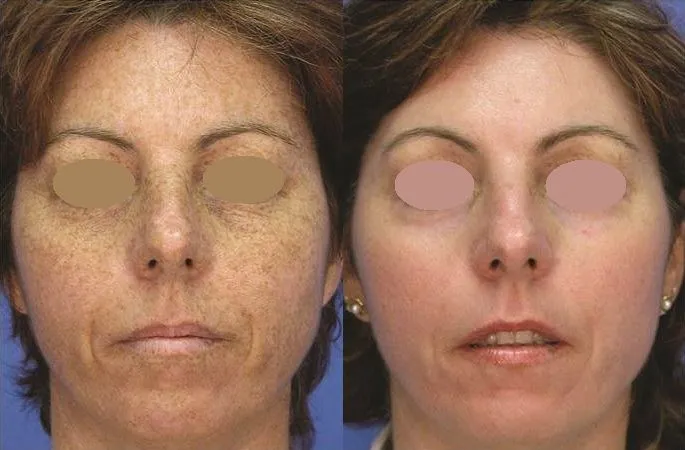 Laser Before And After Pictures Med Spa In Encino Ca A E Skin