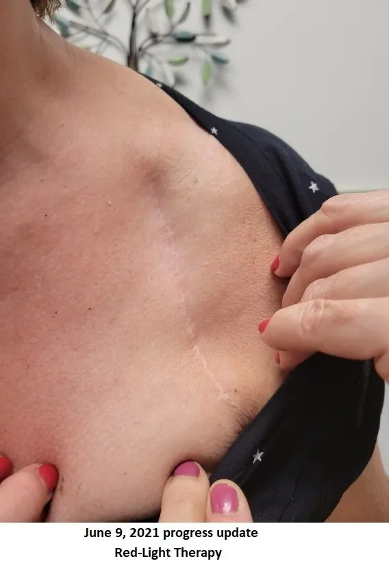 Post surgical scar RLT