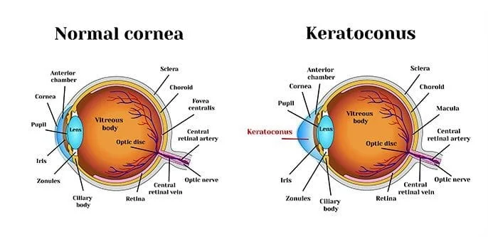 Keratoconus Treatment from Your Houston Ophthalmologists and Optometrists