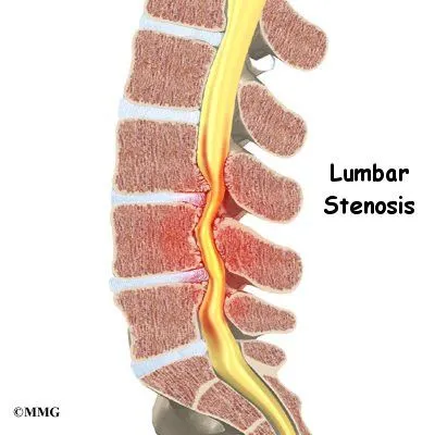 lumbar stenosis