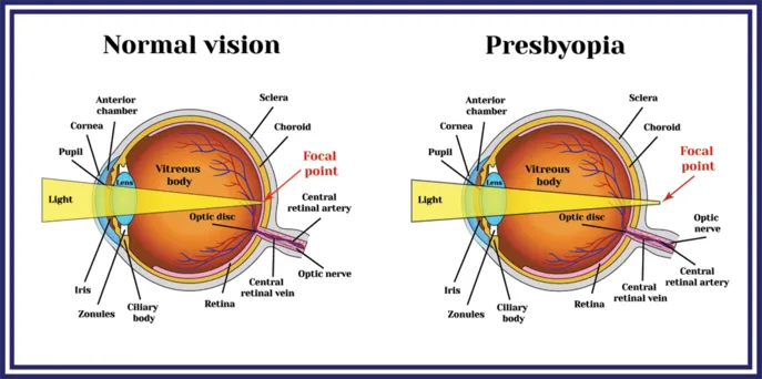  Presbyopia