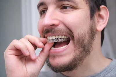 man placing clear aligner tray onto top teeth, Invisalign Hayward, CA orthodontics