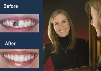 missing front tooth bridge