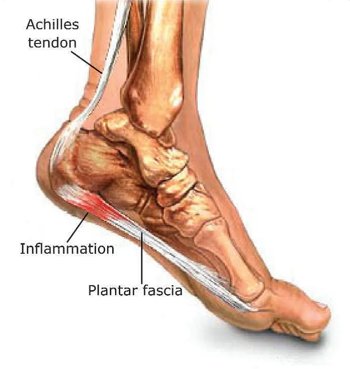 5 Common Causes of Heel Pain
