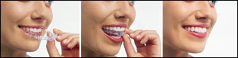 What is InvisalignÂ®?