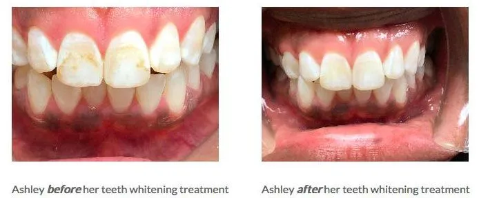teeth whitening | Dentist In Great Neck And Forest Hills, NY