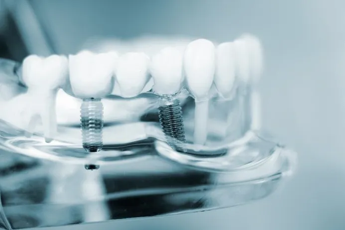 Dental Implants - Kenosha, WI Dentist | Modern Family Dentists