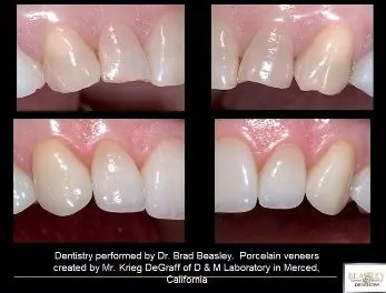 porcelain veneers before after