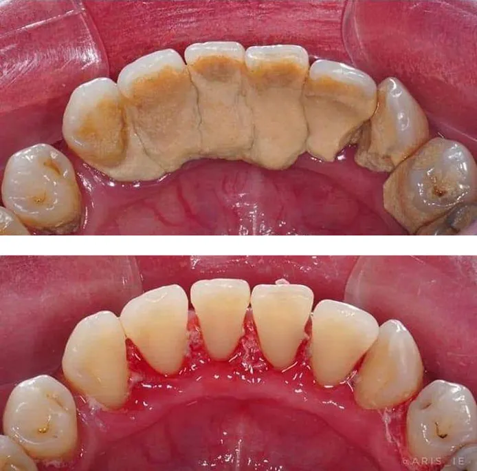 Before and after Professional Cleaning