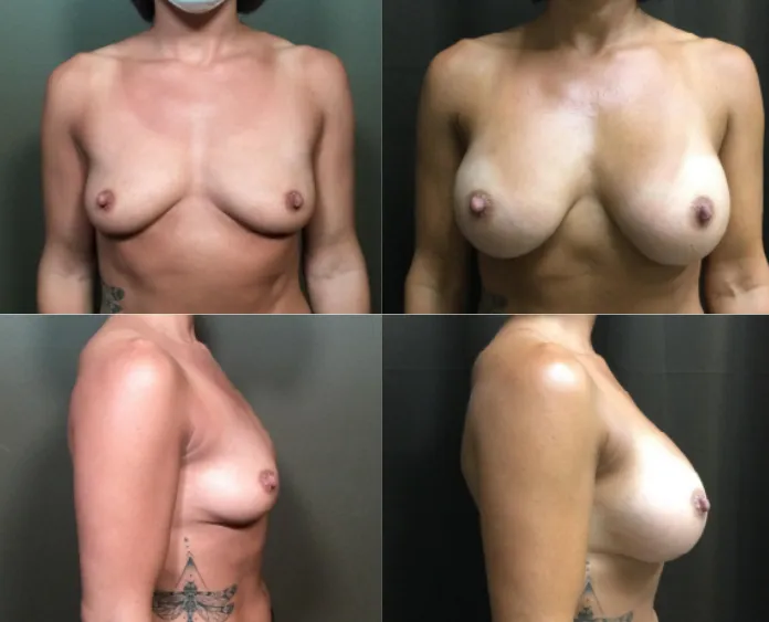 Breast Augmentation Before and After_13