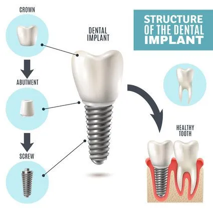 diagram "Structure of the Dental Implant" showing implant parts and placement, dental implants Durham, NC dentist