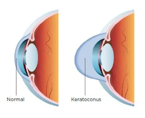 corneal cross link