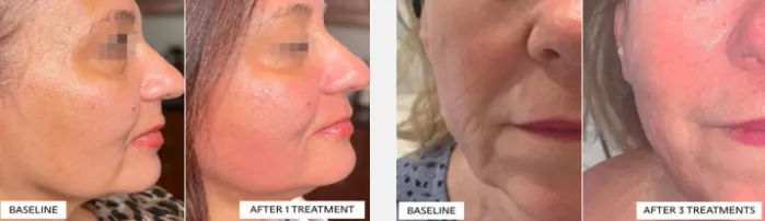 baseline and after treatment