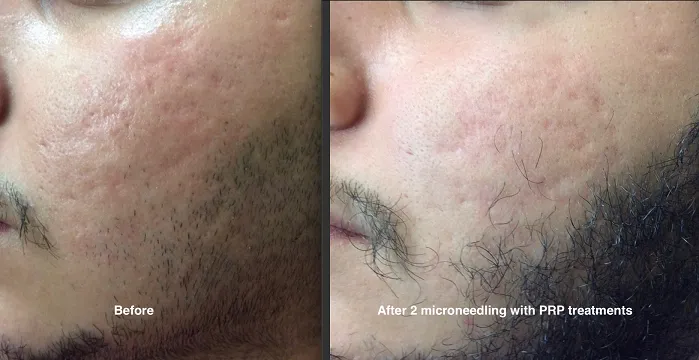 microneedling with PRP