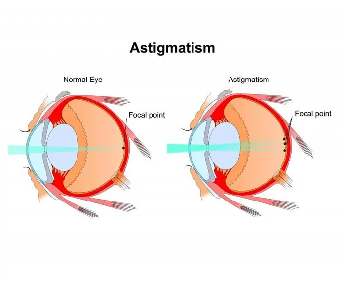 astigmatism