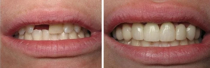 This is an example of a dental implant