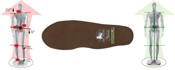 Custom Orthotics - Bridgewater, Denville, Hillsborough, Little