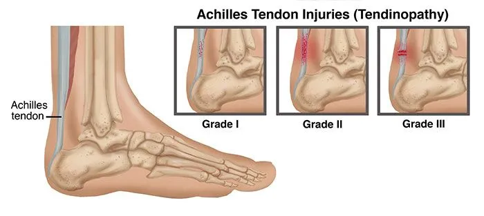 Achilles Tedonitis