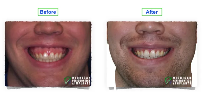 Before & After Bleeding gums Wakefield MA