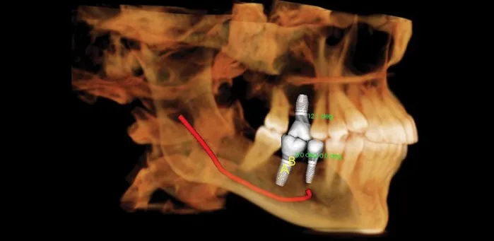 Dental Implant.