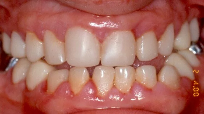 image of full mouth restoration of defective pediatric teeth
