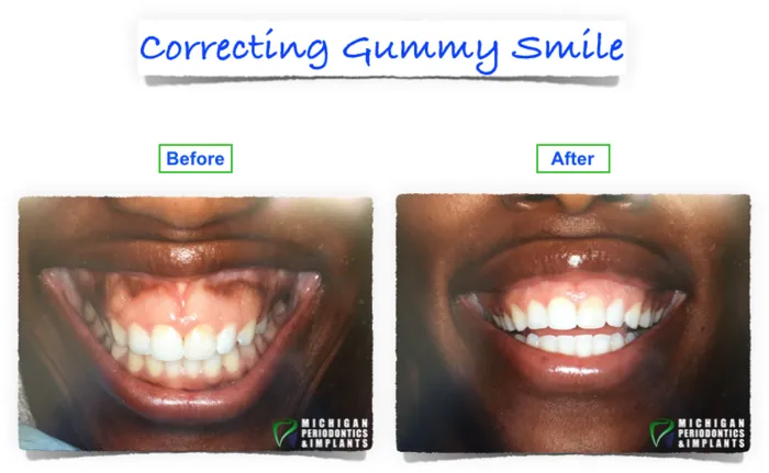 Before and After Gummy Smile