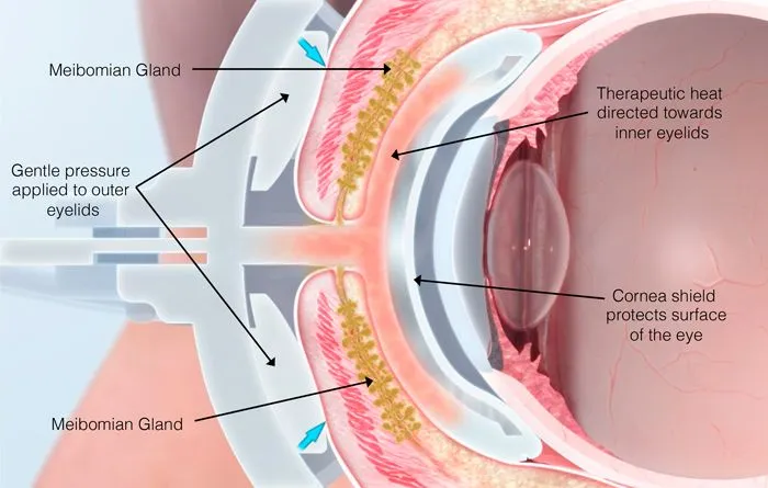 treat Meibomian Gland Dysfunction/MGD