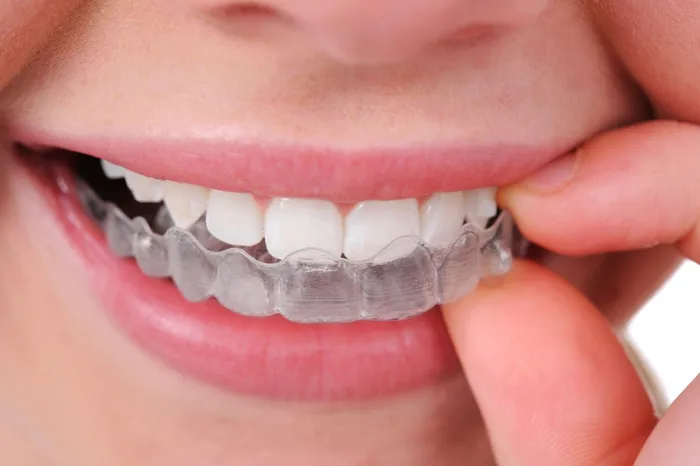 invisalign_photo_aligners