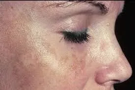 Melasma on Face