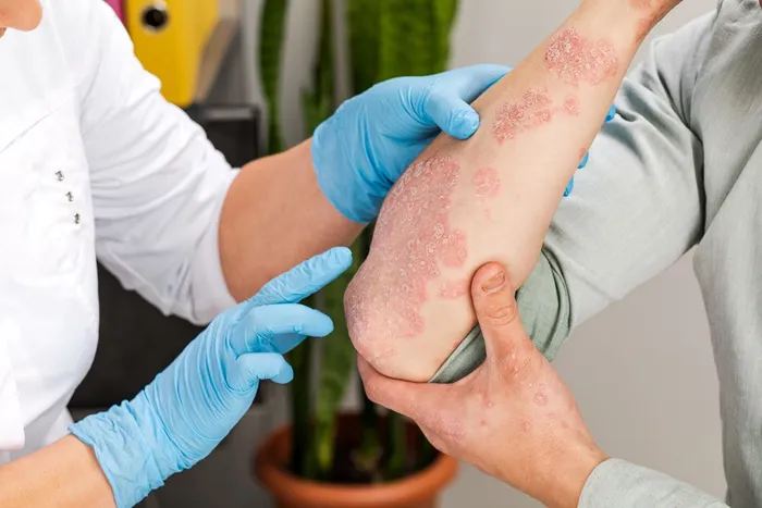 Psoriasis, dermatologist in OMAHA, NE