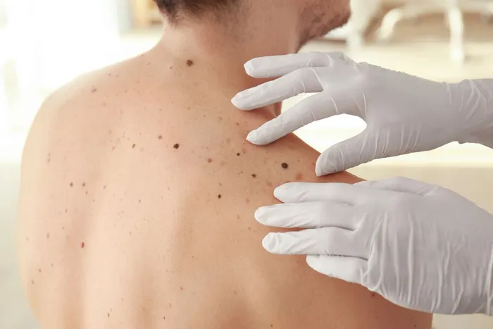 MOLE REMOVAL, dermatologist in OMAHA, NE