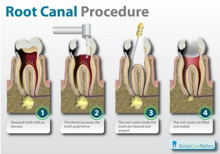  What is a "root canal" procedure like?