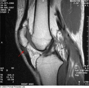 Patellar_tendonitis_MRI.jpg