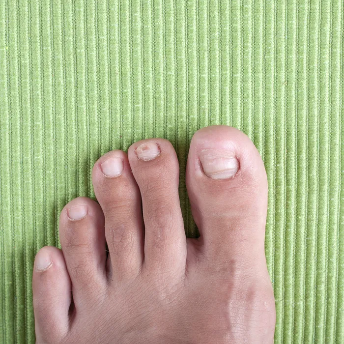 Ingrown Toenails