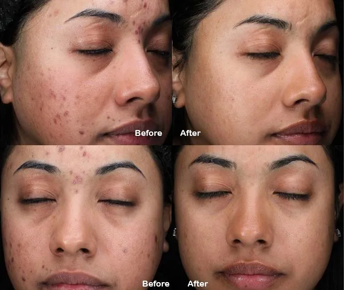 Before and After