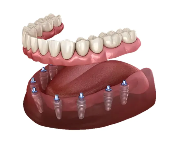 full-tooth-dental-implants