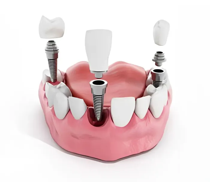 Multiple Dental Implants | Dental Implants Bloomfield Hills | Rochester hills MI