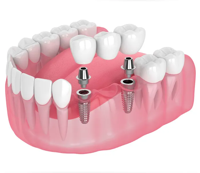 single multi -tooth-dental-implants