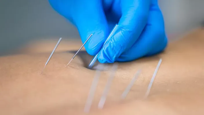 Dry Needling Hamden