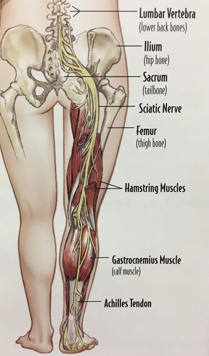 Sciatica