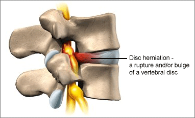 Disc_herniation_Chiropractor_Bozeman__mt.gif