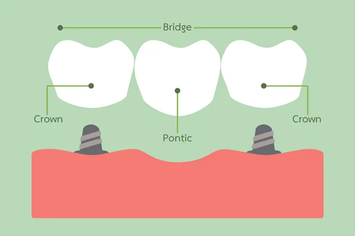 Dental Crowns And Bridges | Dentist in Fairfax, VA | Progressive Dental Care